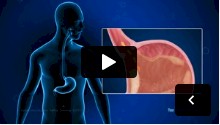 Gastroesophageal Reflux Disease