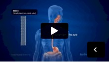 Esophageal Stenting