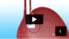 Transoral Incisionless Fundoplication (TIF)