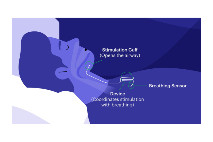 Sleep apnea photo