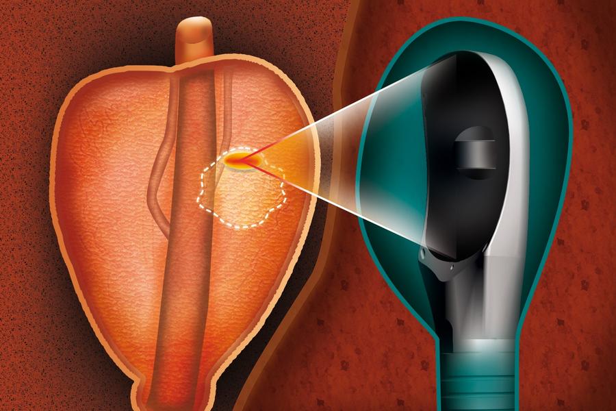 Focal One illustration